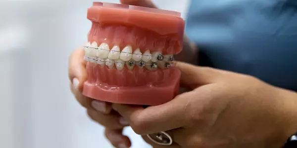 Металлические брекет-системы